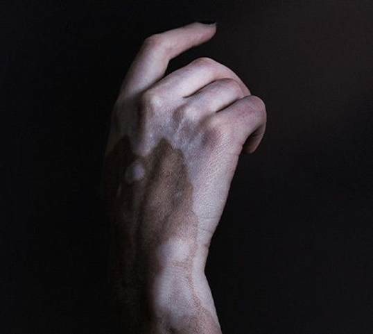 ePGA für Vitiligo background
